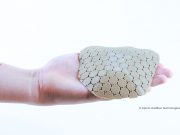 3D-gedrucktes Schädelimplantat aus PEEK
