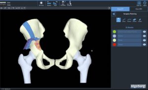 Interview mit Vikas Karade von AlgoSurg: Von CT-Daten zum 3D-Druck – wie KI medizinische Workflows automatisiert
